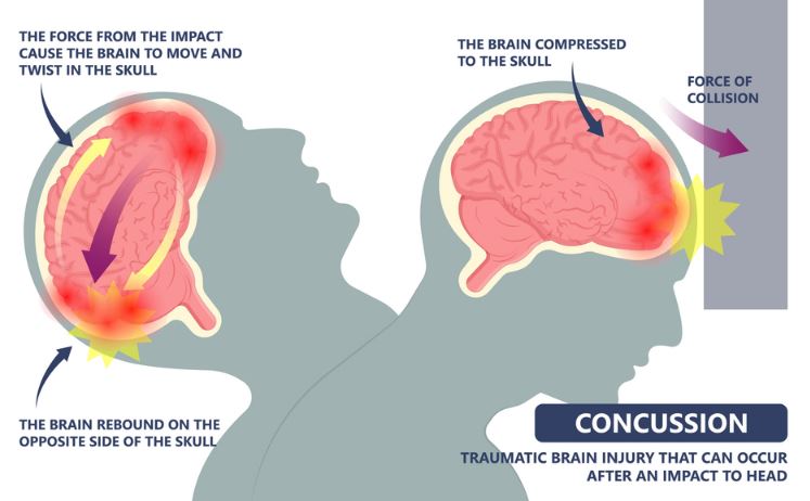 Concussion Migraine